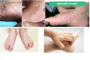 Nổi mụn nước và ngứa ở chân là dấu hiệu bệnh gì?