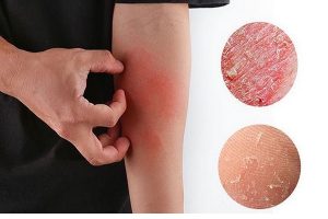 Bệnh gì gây ngứa da và cách điều trị hiệu quả