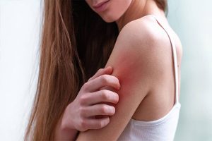 Nổi ban đỏ ngứa trên da là triệu chứng bệnh gì?
