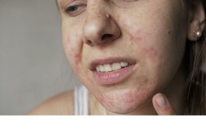 Da mặt sần sùi mẩn ngứa điều trị thế nào?