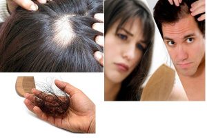 Dấu hiệu rụng tóc nhiều có phải bị bệnh gì không?