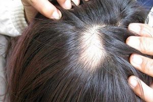 Những biện pháp chữa trị tóc thưa hiệu quả