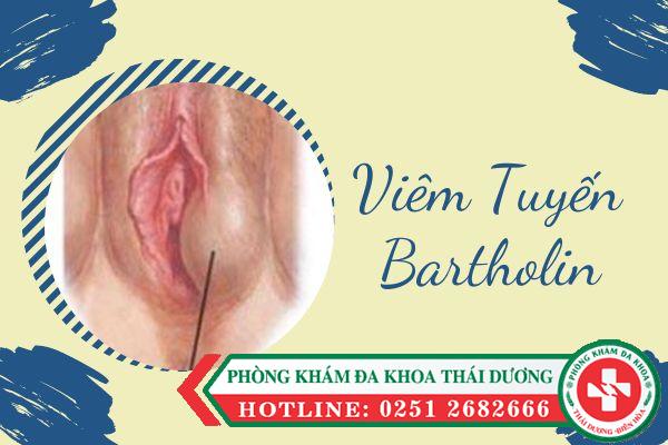 nhung-thong-tin-ve-benh-viem-tuyen-bartholin-1